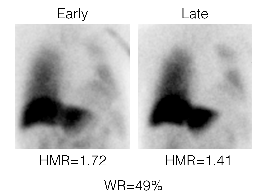 CHF sample