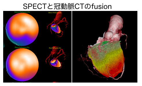 CTA-SPECT fusion